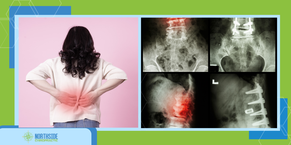 chiro adjustment for spondylolisthesis
